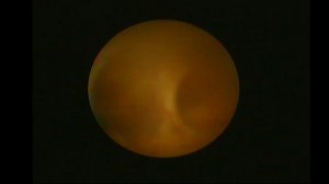 Цистоскопия. Удаление стента правого мочеточника. Уретероскопия справа.