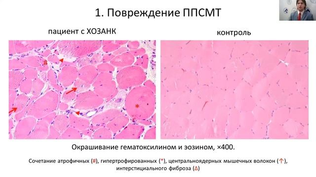 Хроническое ишемическое повреждение скелетных мышц. Сhronic limb ischemia смотреть онлайн