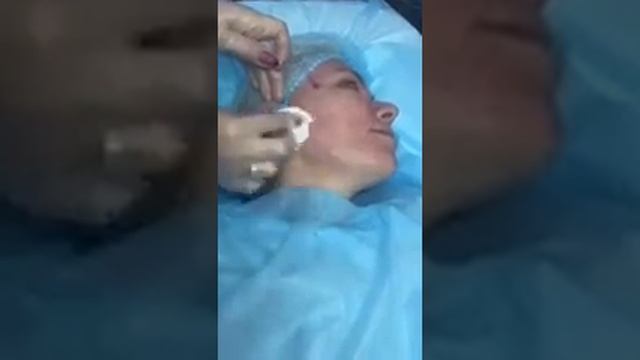 Нитевой лифтинг , тредлифтинг , thread lifting смотреть онлайн