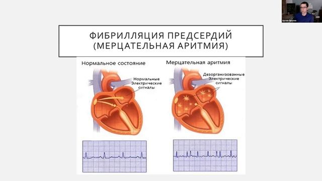 "Нарушения ритма сердца и йога". Артём Фролов. смотреть онлайн