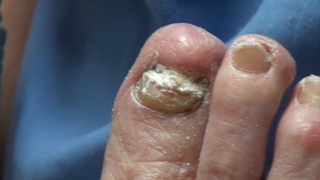 What Causes Thick Toenails?  The Baker And Her Thick Toenails And Callus Trimming