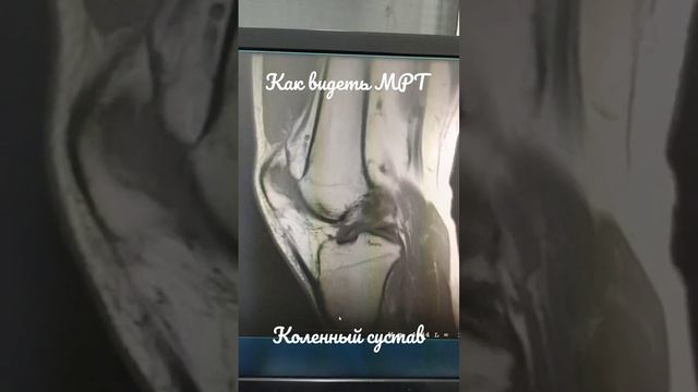 Как видеть МРТ коленный сустав смотреть онлайн