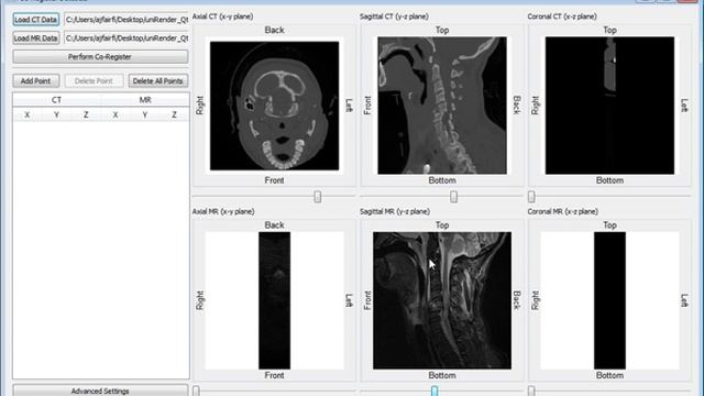 MR/CT Volume Co Registration смотреть онлайн
