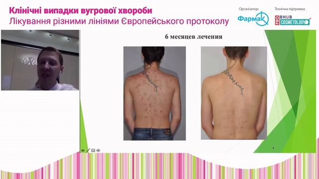 Тема: "Клінічні випадки вугрової хвороби. Лікування різними лініями Європейського протоколу" смотреть онлайн