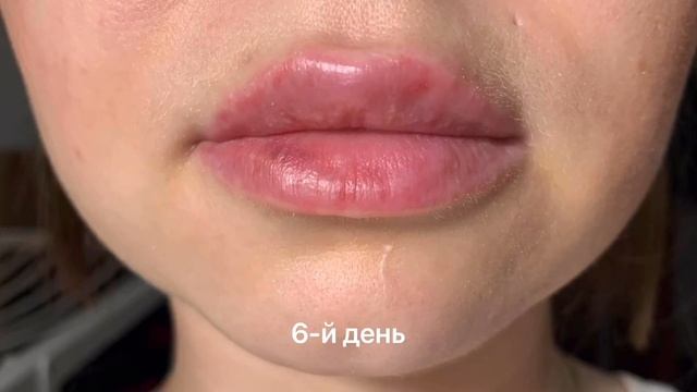 Губы после увеличения. Процесс заживления. Увеличение губ гиалуроновой кислотой смотреть онлайн