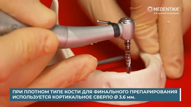 Установка имплантата Medentika Quattrocone без навигации смотреть онлайн