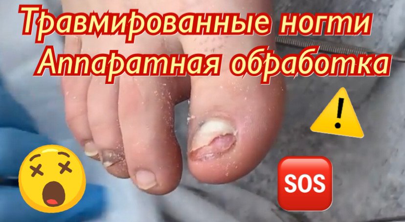 Обработка травмированных ногтей?????⚠️ смотреть онлайн