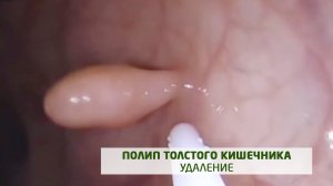 Полип кишечника. Полипэктомия. Видеоколоноскопия под наркозом