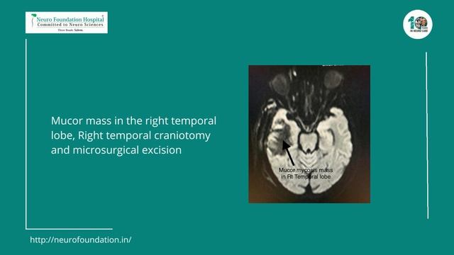 Mucor Mass in Right Temporal Lobe смотреть онлайн