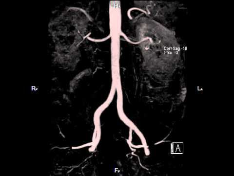 Контрастно усиленная МР ангиография брюшной аорты смотреть онлайн
