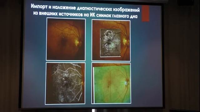 Навигационная технология для лечения патологии макулярной области смотреть онлайн