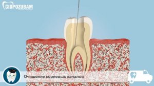 Лечение пульпита: реставрация на штифте после лечения пульпита.