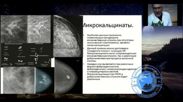 Mammography BI RADS МУСТАФИН ЧИНГИС