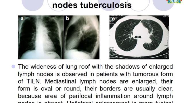 Tuberculosis of intrathoracic lymph nodes смотреть онлайн