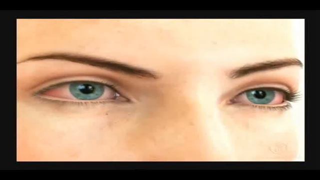 Синдром сухого глаза смотреть онлайн