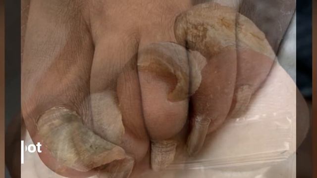 Toenail Fungus! DC Foot Doctor смотреть онлайн