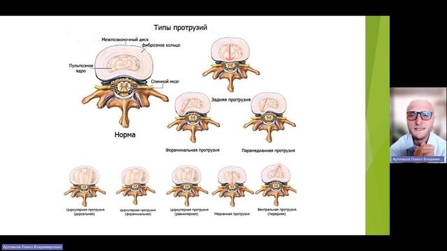 Грыжа в поясничном отделе. Кaк восстaновиться. Методикa физической реaбилитации. Лекция 1 из 3 смотреть онлайн