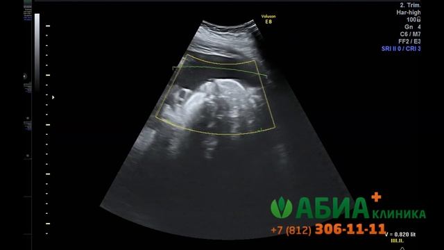 3D УЗИ, 38 недель. Малыш спит. смотреть онлайн