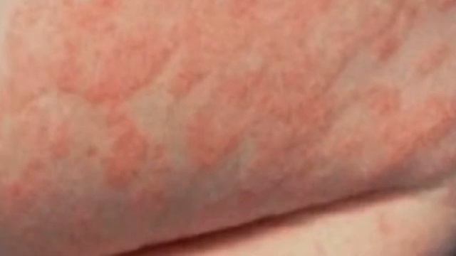 DERMATIT TERI KASALLIGI. ДЕРМАТИТ ТЕРИ КАСАЛЛИГИ.