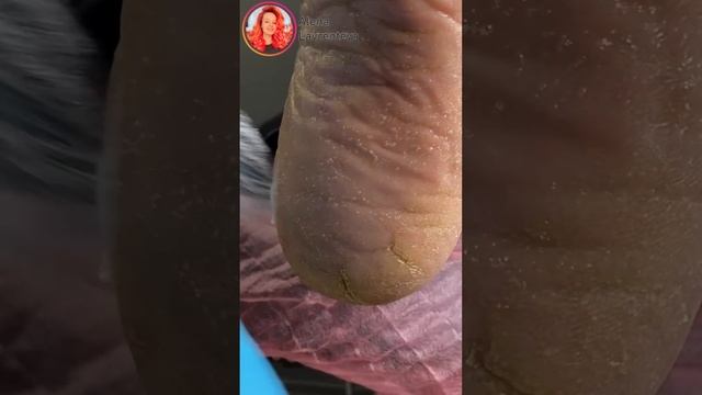 У Клиента подтвердился грибок! А пришел на зачистку пяток! Интересна история полностью? смотреть онлайн