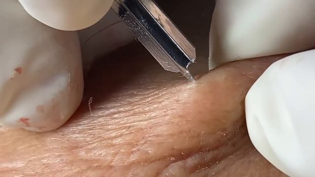 Acne Treatment Huong Da Nang# 064 | Loyal fans смотреть онлайн