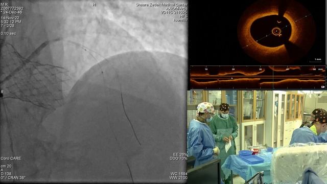 PCI using the new EluNir PERL stent смотреть онлайн
