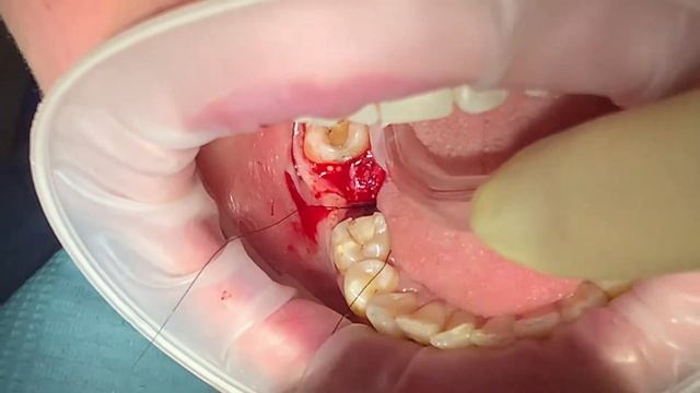 Наложение швов после удаления зуба смотреть онлайн