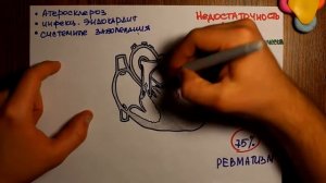 Митральная недостаточность   Просто о сложном