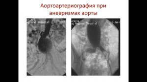 видеолекция аневризмы аорты