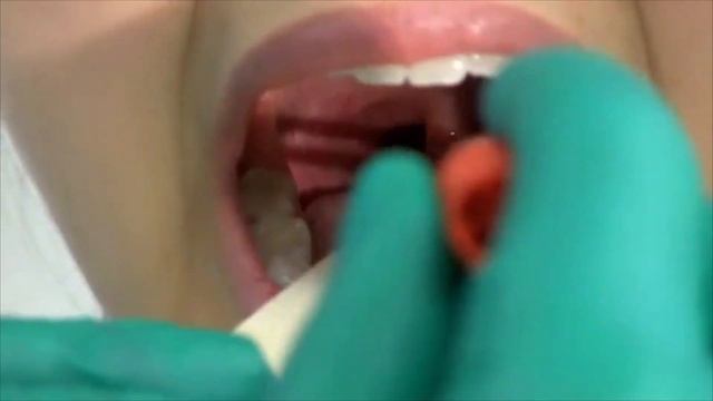 How to perform a throat swab on a patient смотреть онлайн