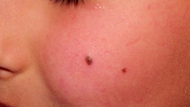 что будет если содрать родинку смотреть онлайн