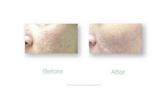 Laser Scar Removal with Palomar Laser смотреть онлайн