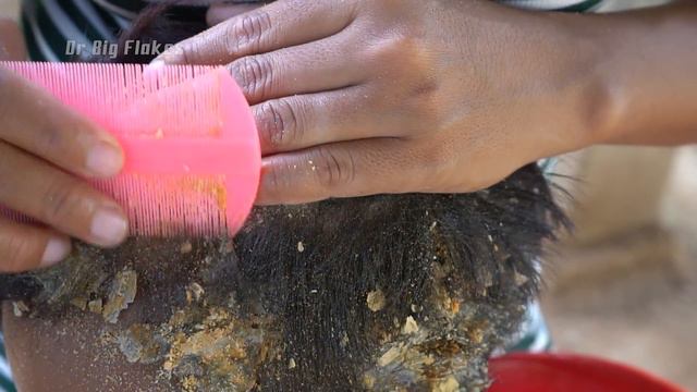 Best Of The Dandruff Scratching!!!( Flake Compilation) | Scratching Big Flakes At Home #73