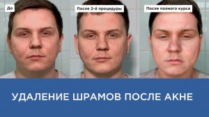 УДАЛЕНИЕ ШРАМОВ ОТ ПОСТАКНЕ
