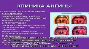 Виды ангины