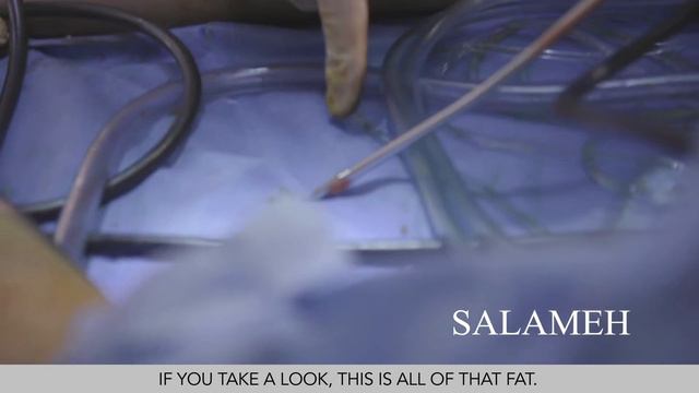 Lipedema Liposuction Demonstration | Front Of The Legs | Salameh