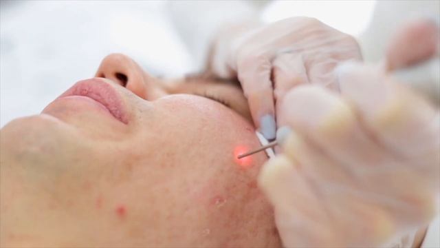 Лазерная шлифовка СО2 смотреть онлайн