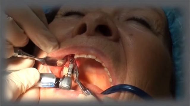 НЕМЕДЛЕННАЯ НАГРУЗКА. НЕБОЛЬШОЙ НЕСЪЁМНЫЙ МОСТОВИДНЫЙ ПРОТЕЗ А.П. - DVD 2015 - 07 RUS смотреть онлайн