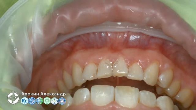 Professional oral hygiene - case 002 Acteon, DTE, Dentsply Sirona, Coxo, 3M, KerrHawe (livestream) смотреть онлайн