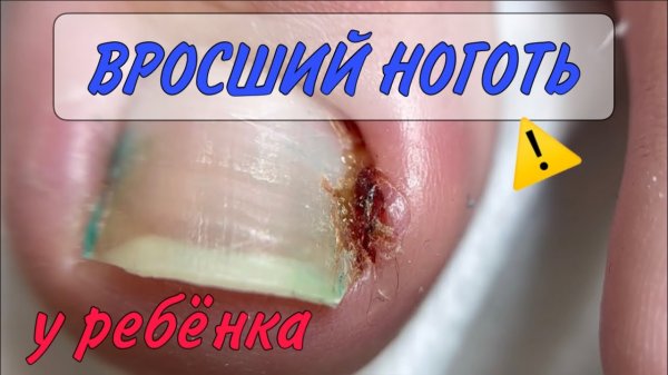 Вросший ноготь у ребенка_ воспаление на пальце_ прием у подолога