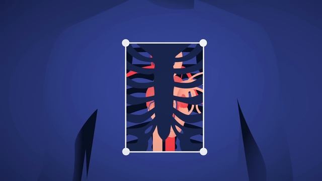 How does heart transplant surgery work? - Roni Shanoada смотреть онлайн