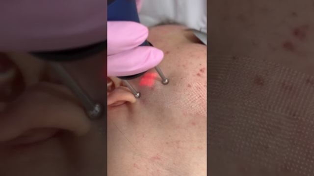 Холодный лазерный пилинг на аппарате Dermablate mcl31 смотреть онлайн