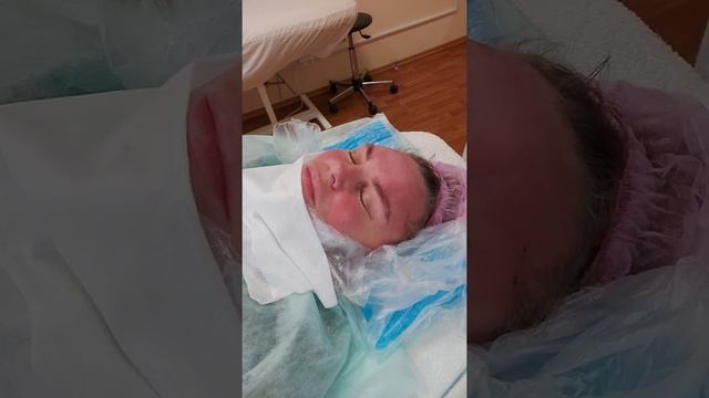 Лифтинг бровей. Установка мезонитей Cog.