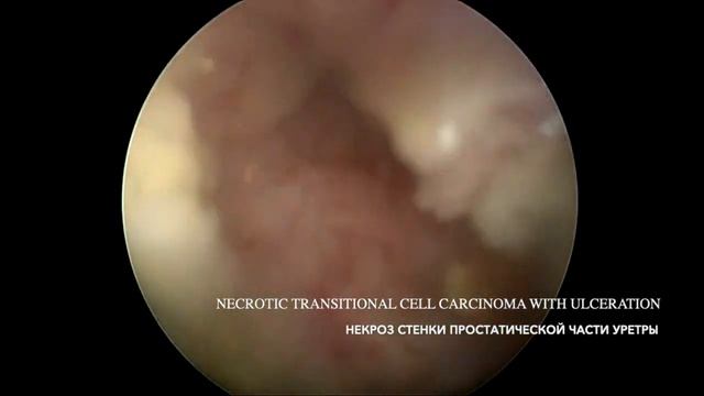 Fimbriated&necrotic bladder TCC/Переходно-клеточная карцинома мочевого пузыря и уретры у собаки смотреть онлайн