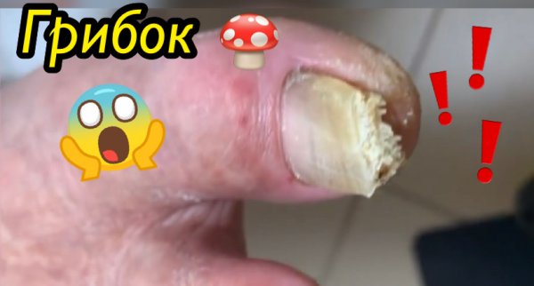 Грибок?