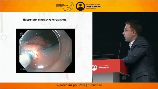 Клинический случай эндоскопической подслизистой диссекции при крупной опухоли прямой кишки