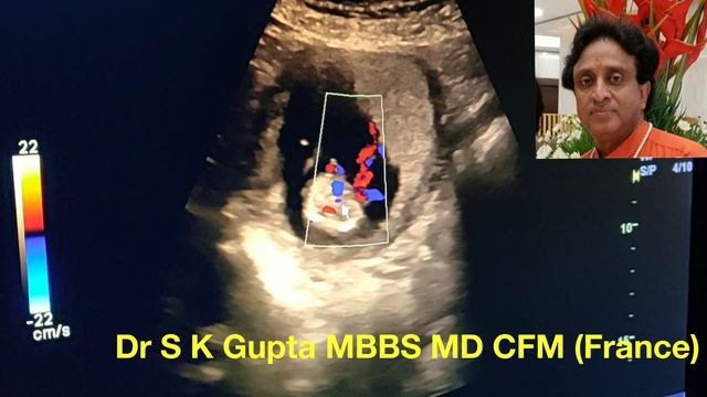 NT NB scan in Twins 13 weeks,Tricks & Tips to see Nasal Bone, Nuchal Translucency,DV Flow,Anomalies смотреть онлайн