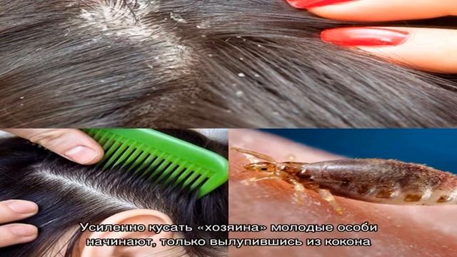 Как понять, что у тебя вши, симптомы и признаки смотреть онлайн