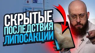 ВСЕ МОЛЧАТ ОБ ЭТИХ ПОСЛЕДСТВИЯХ ЛИПОСАКЦИИ. Какие бывают осложнения после липосакции смотреть онлайн