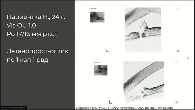Клинический случай недостаточного проведения лазерной иридотомии при закрытоугольной глаукоме. смотреть онлайн
